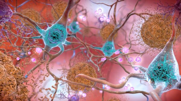 При болезни Паркинсона в нейронах, синтезирующих дофамин (розовые шарики), перестает разрушаться белок альфа-синуклеин, его фибриллы склеиваются и образуют внутри клетки нерастворимые тельца Леви (голубые). Возникает дефицит дофамина