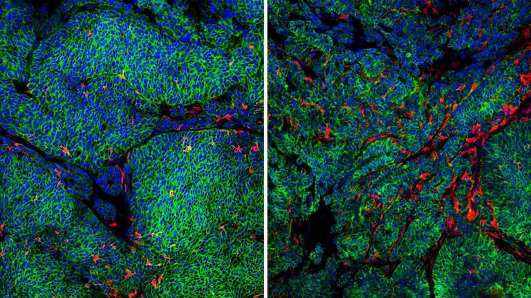 Микрофотографии опухолей мышей. Слева раковые клетки (зеленым) содержат белок CCR2, и в этой опухоли мало дендритных клеток (красным); справа - опухоль, в которой раковые клетки не содержат белка CCR2