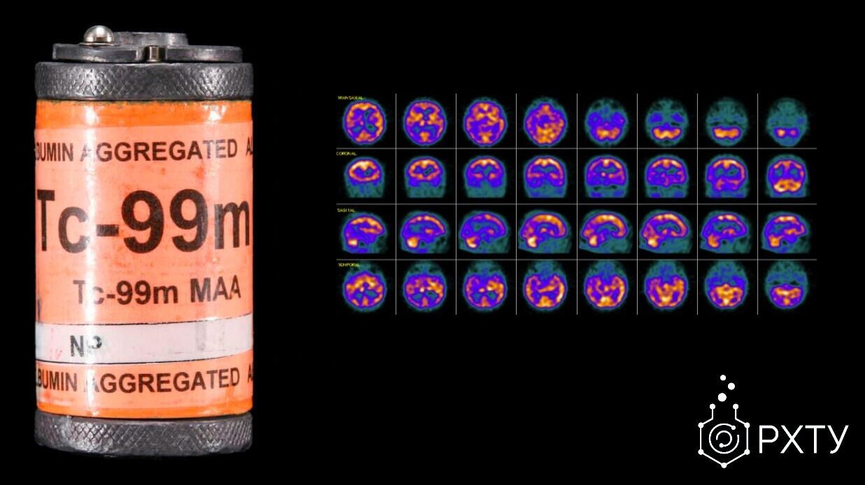 Изображения головного мозга при болезни Альцгеймера, полученные с помощью изотопа технеция  - РИА Новости, 1920, 29.07.2020