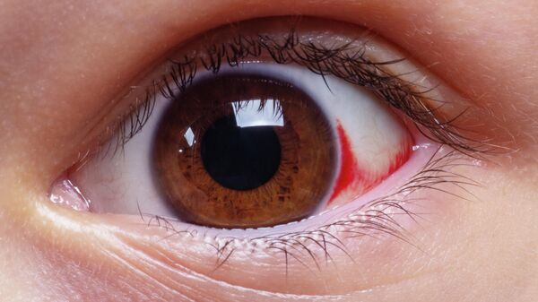 Глаз с гемолакрией