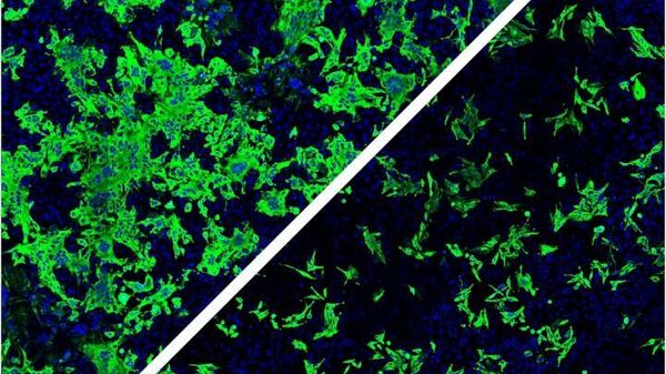 Человеческие клетки, инфицированные SARS-CoV-2. Удаление нейропилина-1 (NRP-1) снижает инфекцию (справа внизу)
