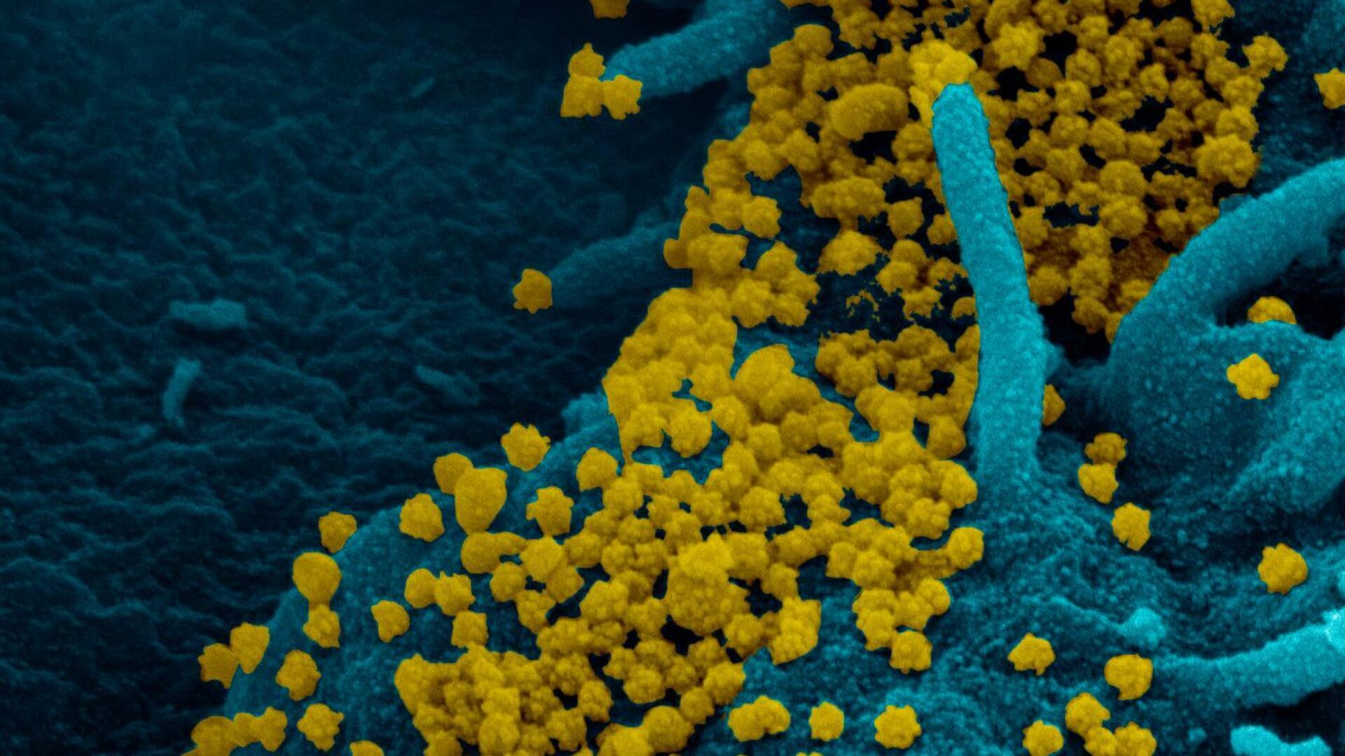Изображение SARS-CoV-2, полученное с помощью сканирующей электронной микроскопии мазка из носоглотки пациентки с ослабленным иммунитетом - РИА Новости, 1920, 11.11.2020