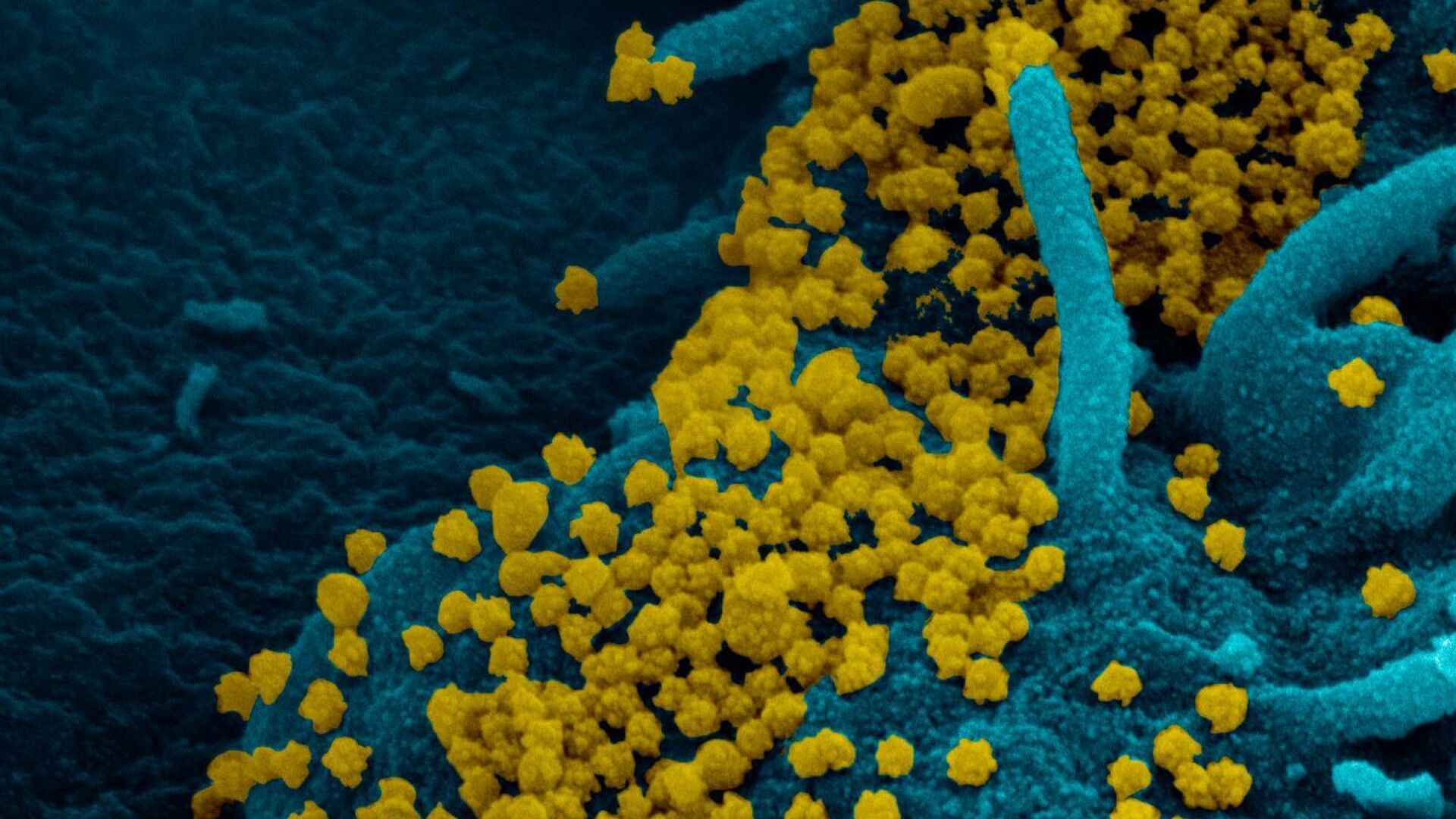 Изображение SARS-CoV-2, полученное с помощью сканирующей электронной микроскопии мазка из носоглотки пациентки с ослабленным иммунитетом - РИА Новости, 1920, 26.11.2020