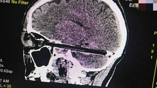 Врачи ростовской больницы извлекли шариковую ручку, прошедшую через глаз и мозг 37-летнего пациента