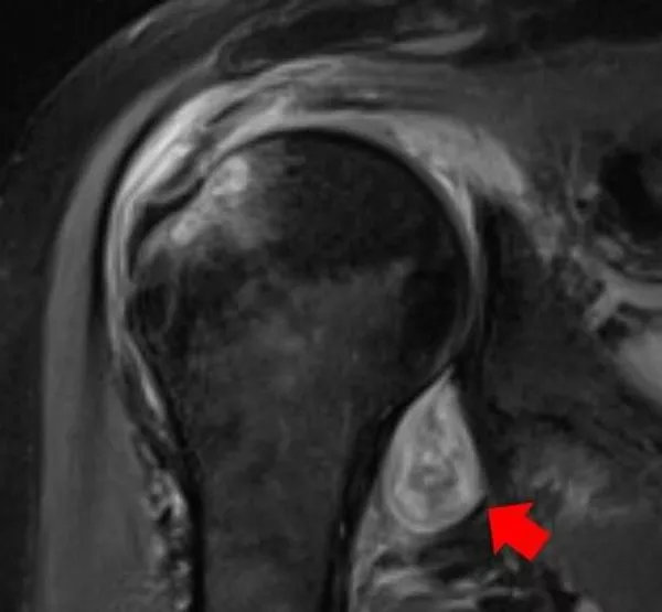 МРТ-изображение плеча пациента. Красная стрелка указывает на воспаление в суставе, вызванное COVID-19