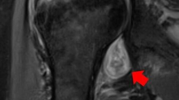 МРТ-изображение плеча пациента. Красная стрелка указывает на воспаление в суставе, вызванное COVID-19