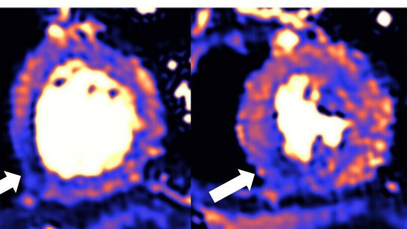 МРТ поврежденного сердца. Синий цвет означает снижение кровотока - РИА Новости, 1920, 18.02.2021