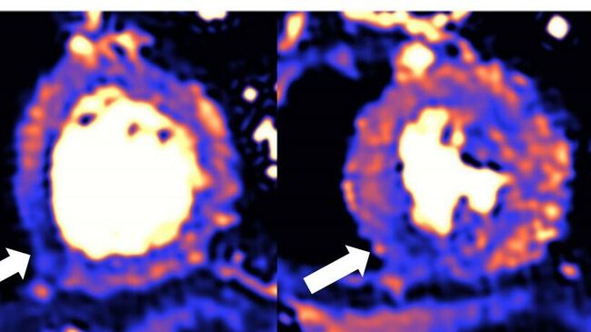 МРТ поврежденного сердца. Синий цвет означает снижение кровотока