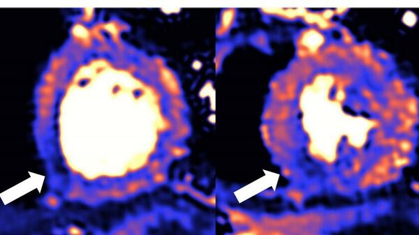 МРТ поврежденного сердца. Синий цвет означает снижение кровотока