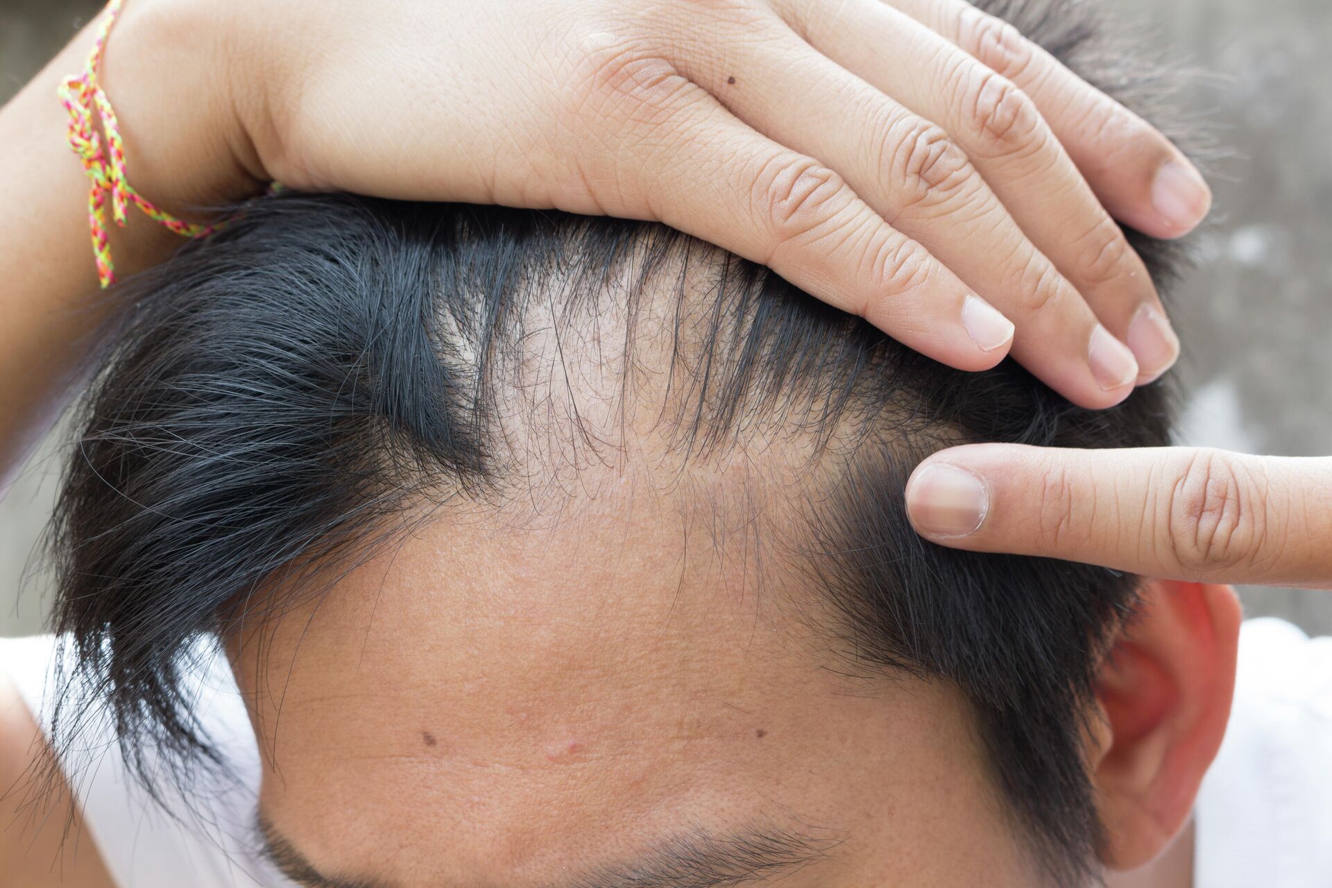 Как восстановить волосы после операции на голове в домашних условиях