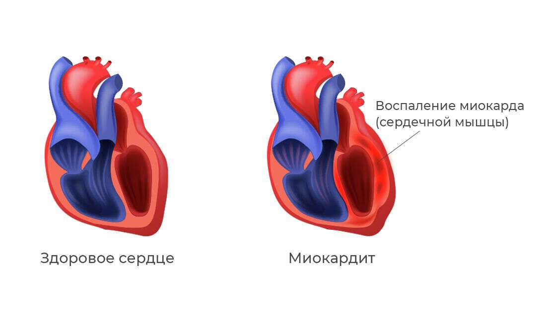 Миокардит - РИА Новости, 1920, 18.08.2021