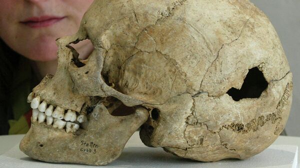 Женский череп из Штеттена-ан-дер-Донау с трепанационным отверстием на левой теменной кости