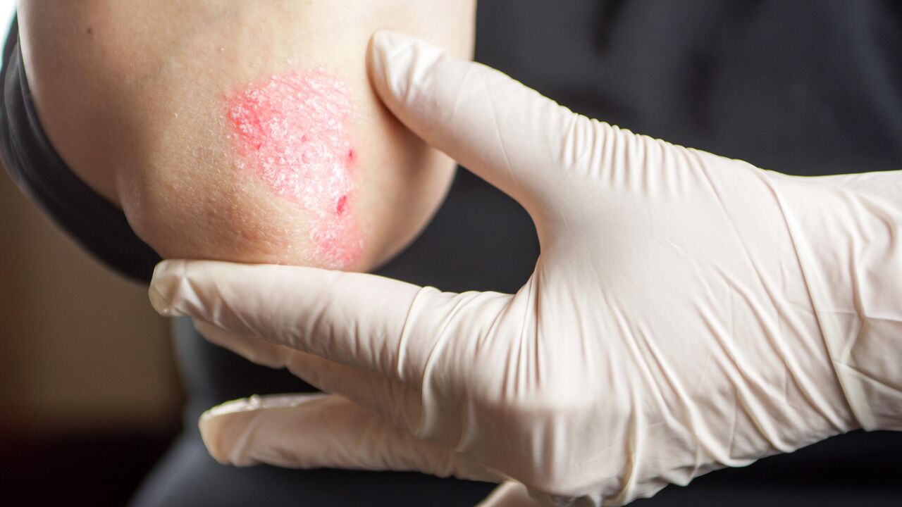 Грибковые заболевания кожи: симптомы и лечение, как избавиться от патологии навсегда