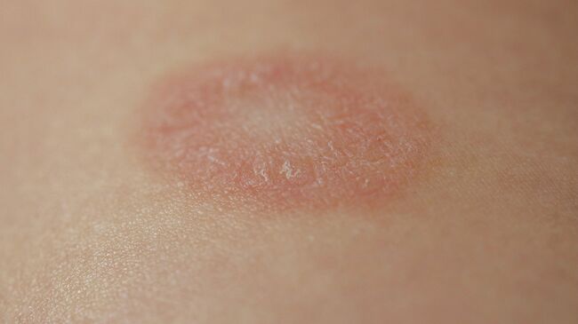 Розовый лишай