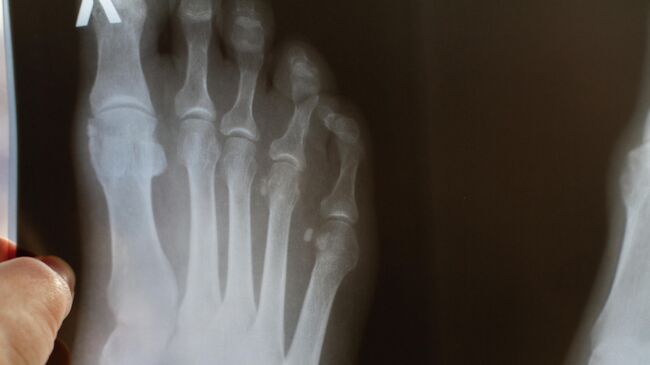 Рентгеновский снимок стопы с переломом большого пальца 