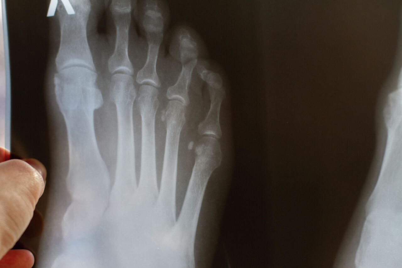 Перелом пальцев ноги - причины, симптомы, диагностика и лечение в Москве