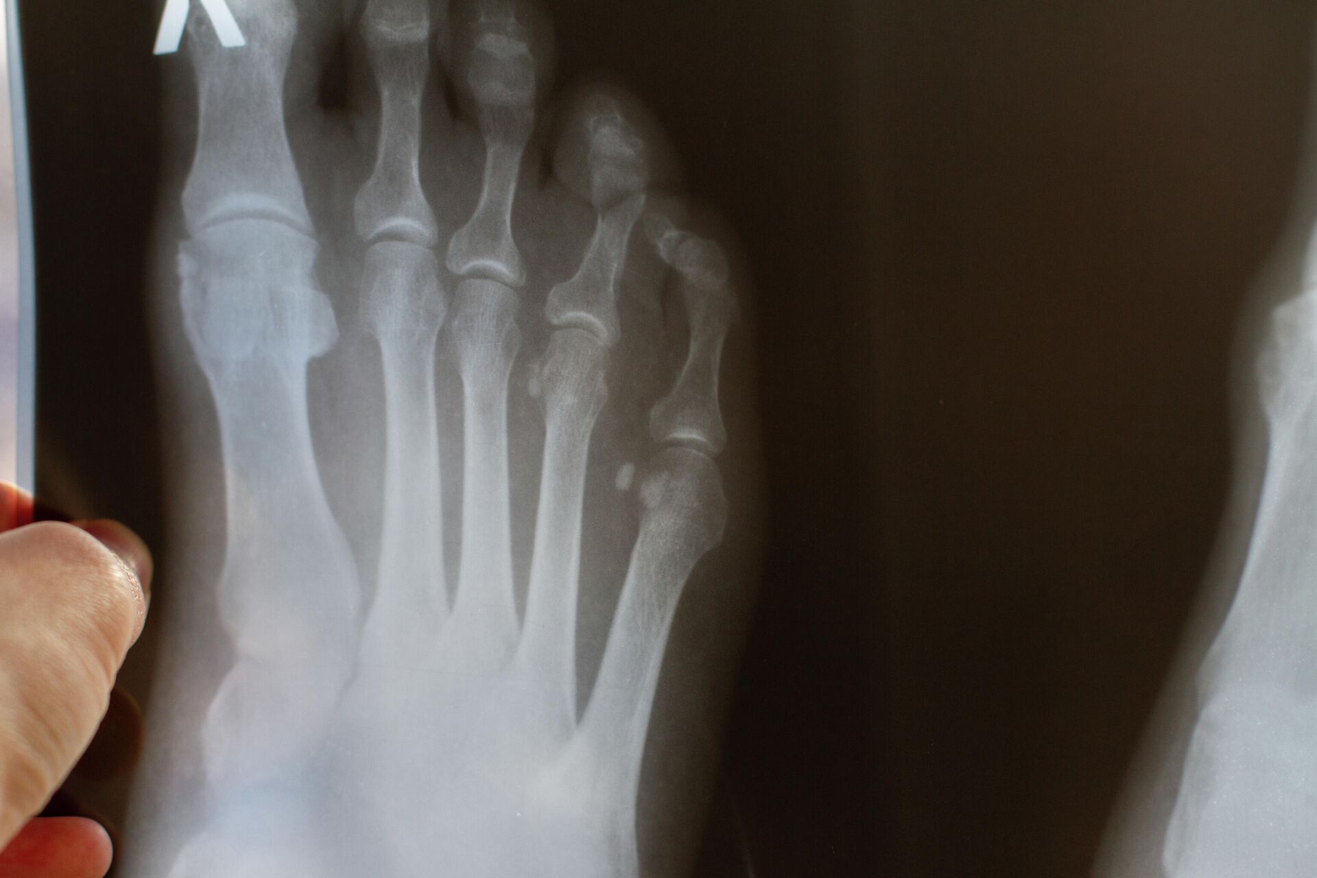 Травма ногтя на руке или ноге - лечение и восстановление после