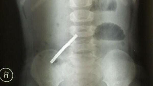Рентгеновский снимок девочки, проглотившей магниты