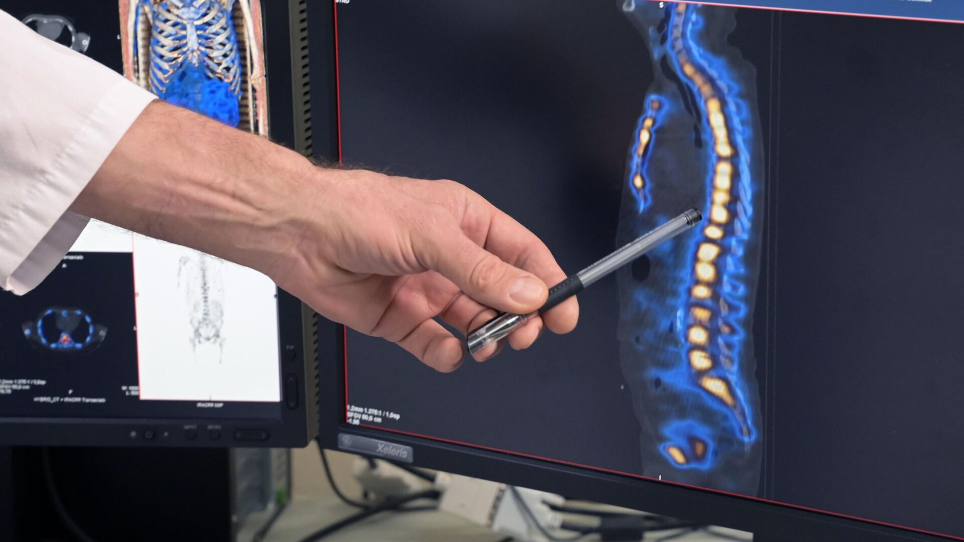 Участки позвоночника больного, пораженные метастазами, на экране монитора в отделе лучевой диагностики в отделении экспериментальной ядерной медицины МРНЦ имени А. Ф. Цыба - филиала ФГБУ НМИЦ радиологии Минздрава России - РИА Новости, 1920, 04.02.2022