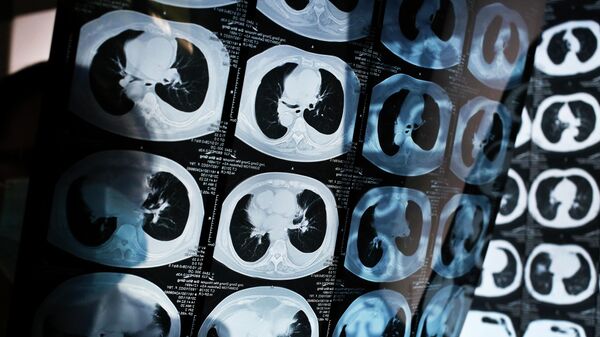 Врач просматривает компьютерную томографию больных раком легких в Китае