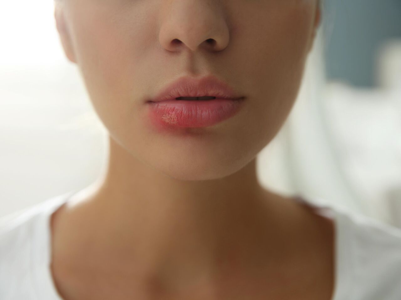 Герпес губ: причины, проявления, лечение