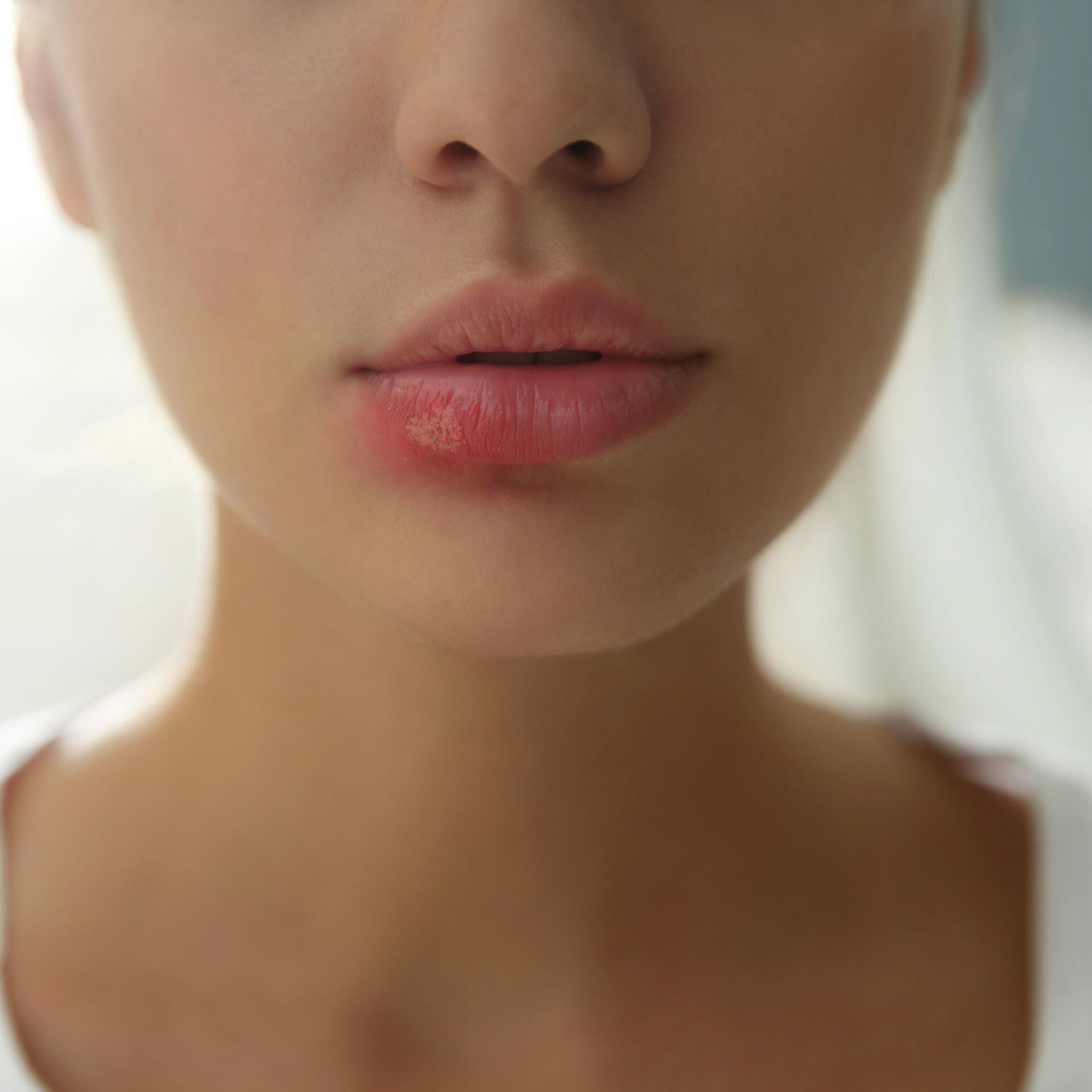 Герпес на губе — причины возникновения, симптомы и лечение в MAJOR CLINIC