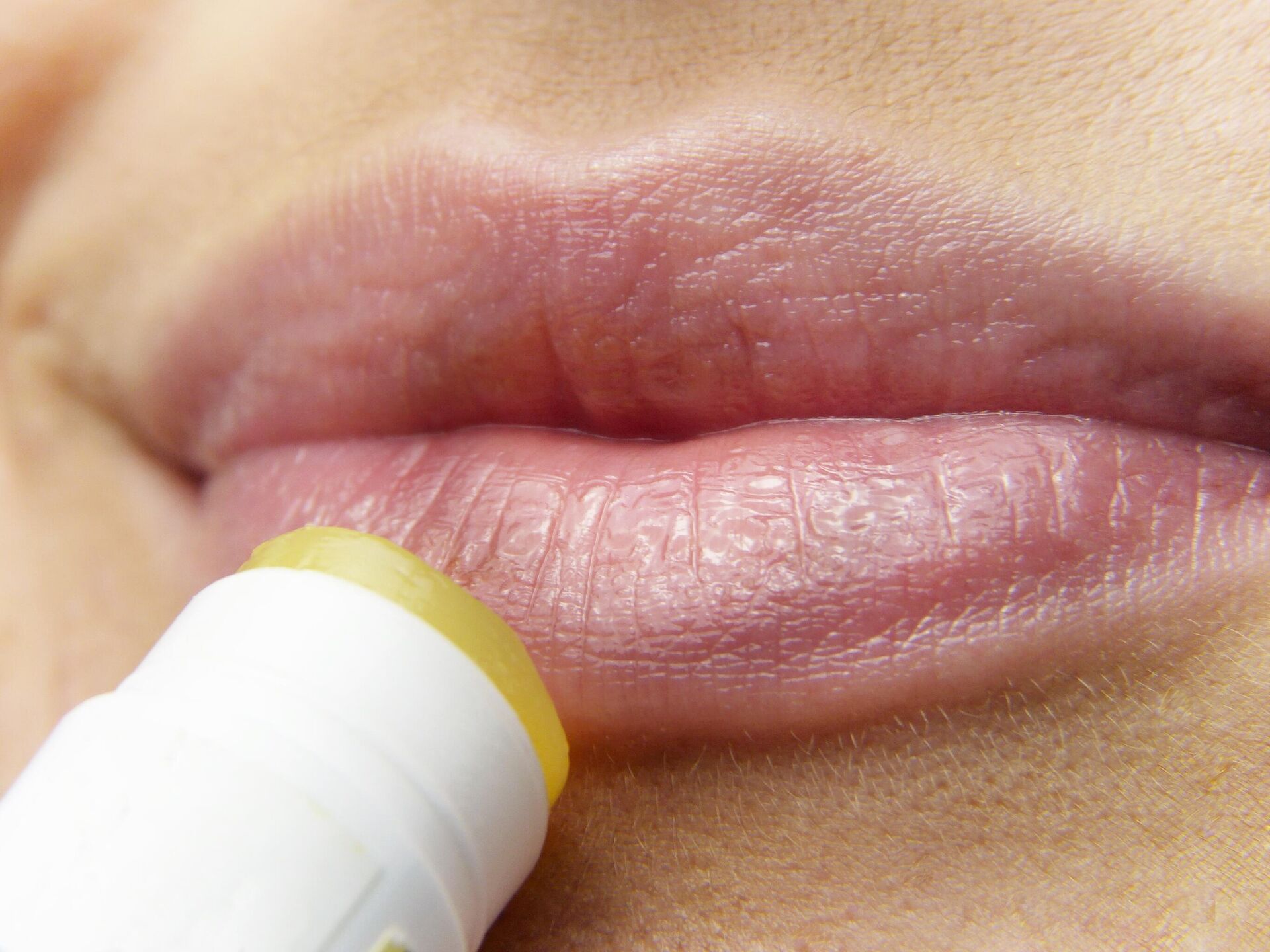 Как предотвратить появление герпетических болячек на губах