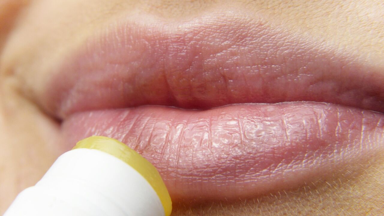 Herpes after lip augmentation: how to treat and who is to blame