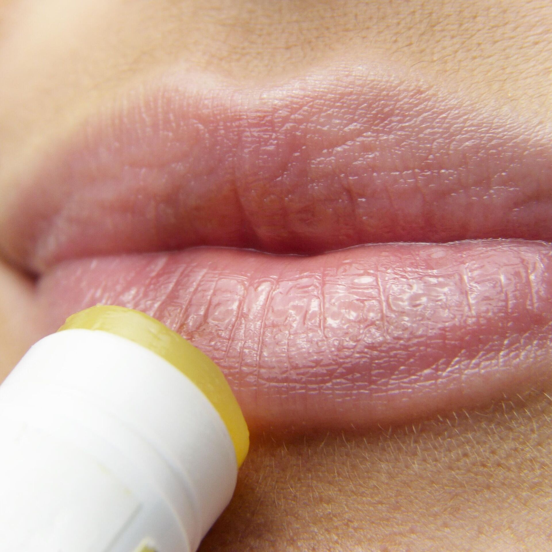 Герпес на губах: лечение - Coolaser Clinic