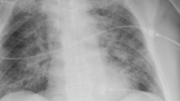 Вирусная пневмония на рентгеновском снимке