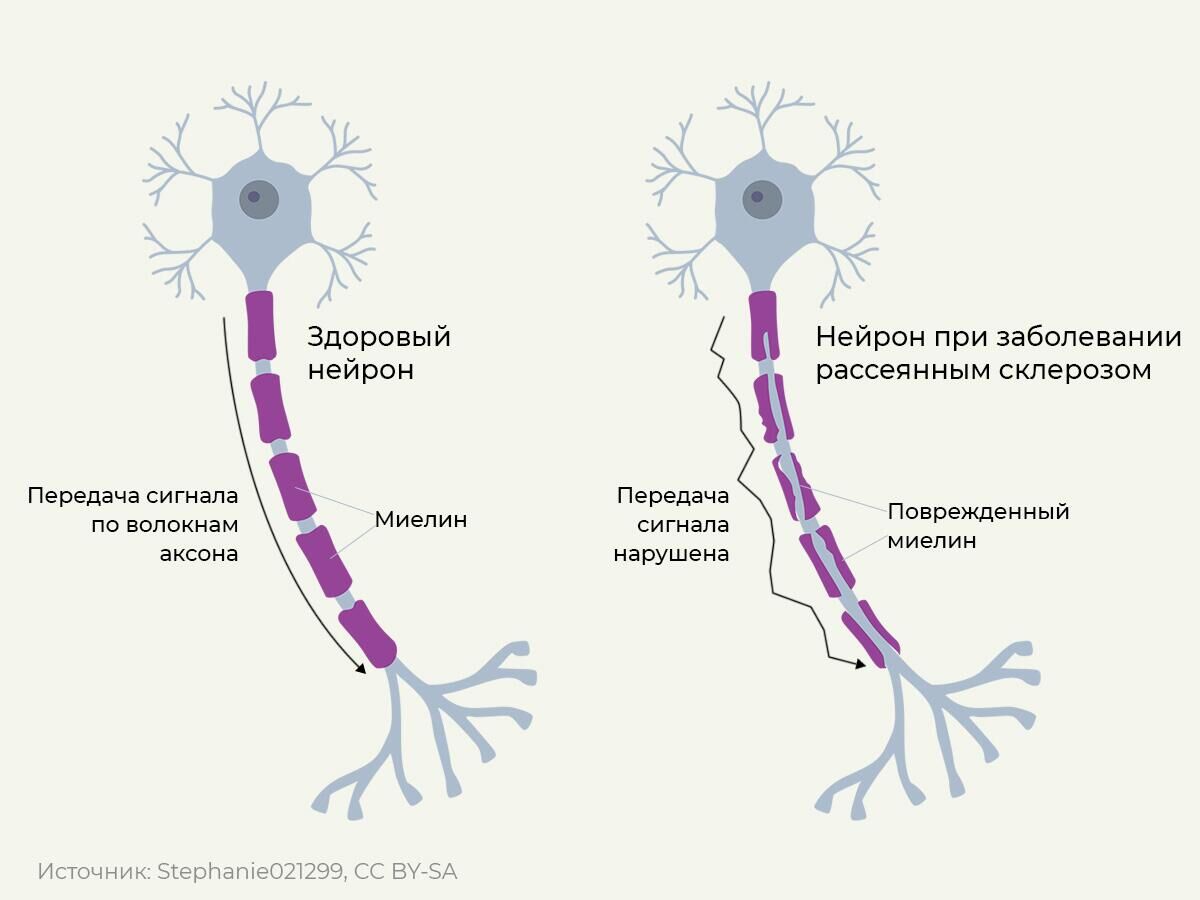 Поражение нервных клеток при рассеянном склерозе - РИА Новости, 1920, 23.05.2022