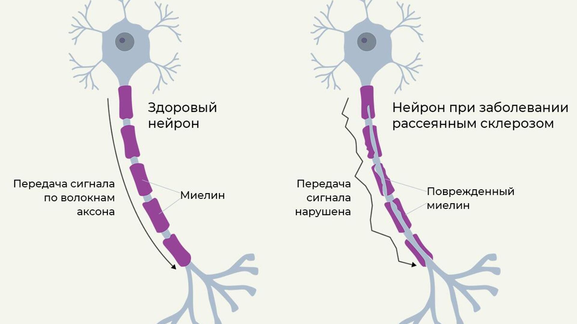 Врачи рассказали, сколько в мире больных рассеянным склерозом - РИА  Новости, 27.05.2024