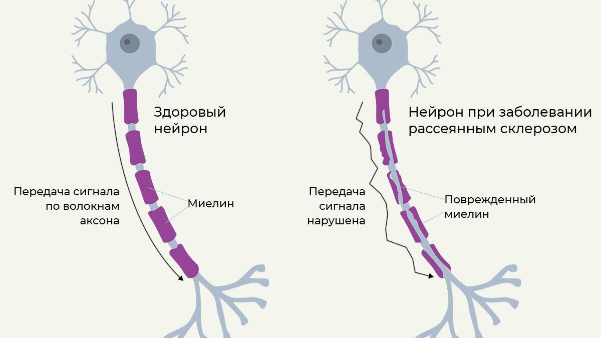 Поражение нервных клеток при рассеянном склерозе - РИА Новости, 1920, 27.05.2024