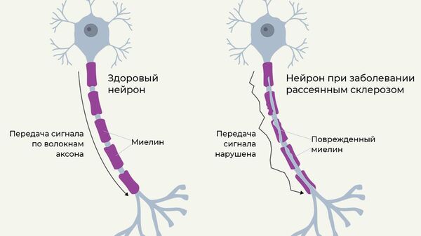 Поражение нервных клеток при рассеянном склерозе