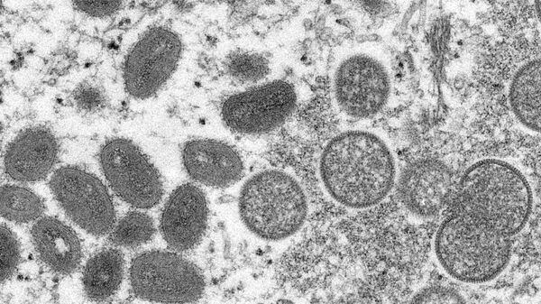 Образец кожи человека с вирусом оспы обезьян под микроскопом. Архивное фото