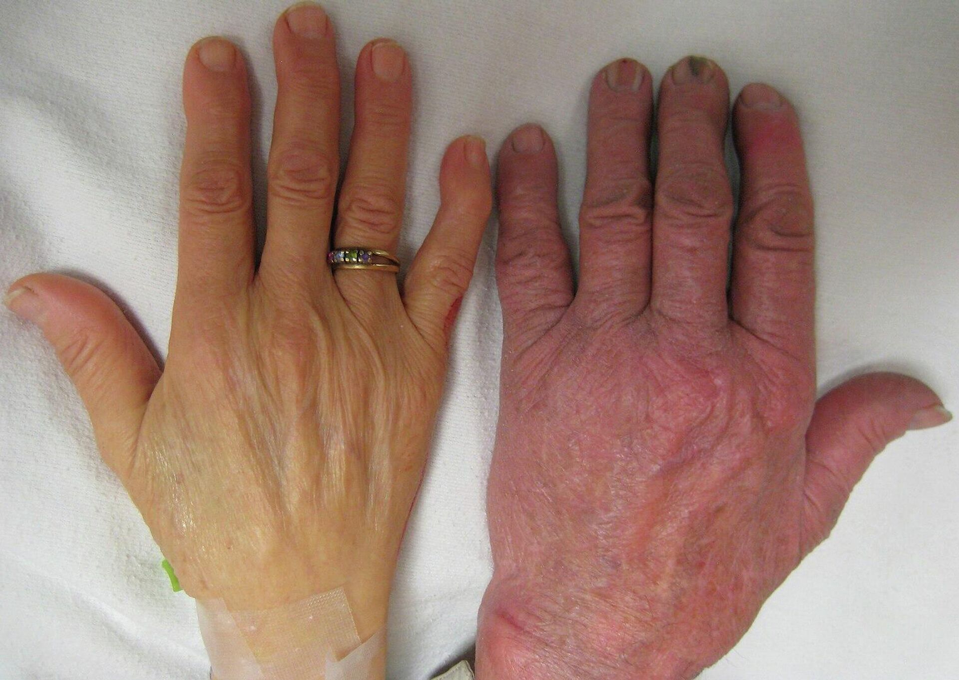 Рука человека с тяжелой анемией (слева, с кольцом) по сравнению с рукой без (справа) - РИА Новости, 1920, 23.06.2022