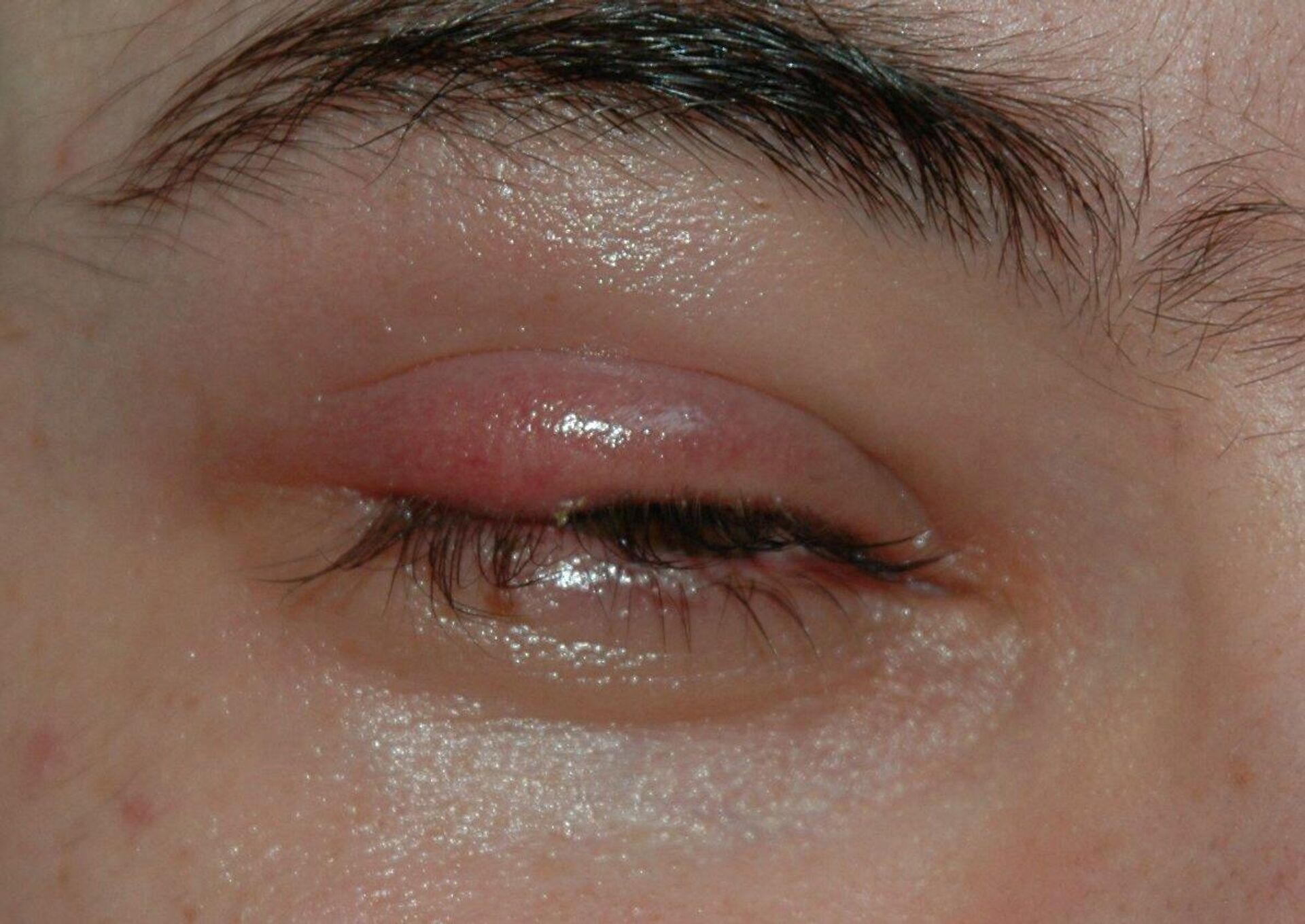 Ячмень на глазу - признаки, симптомы, причины, диагностика и способы лечения заболевания