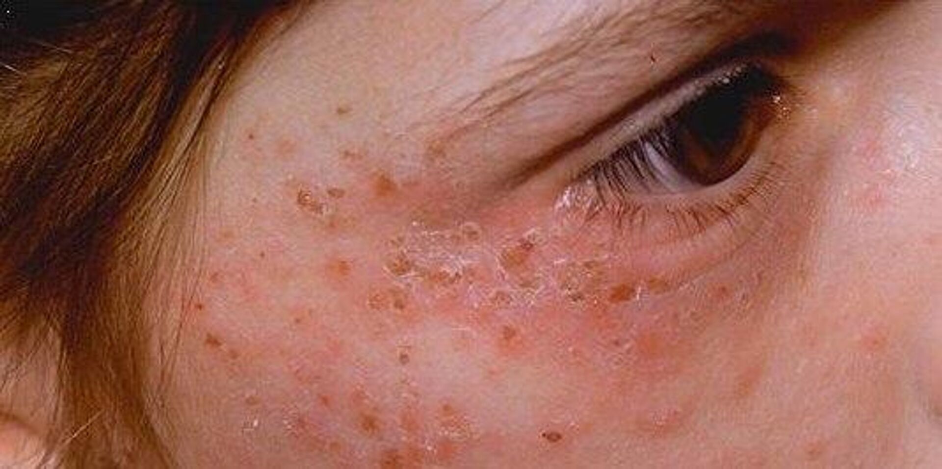 Аллергия на солнце: что это такое, как выглядит и как ее лечить