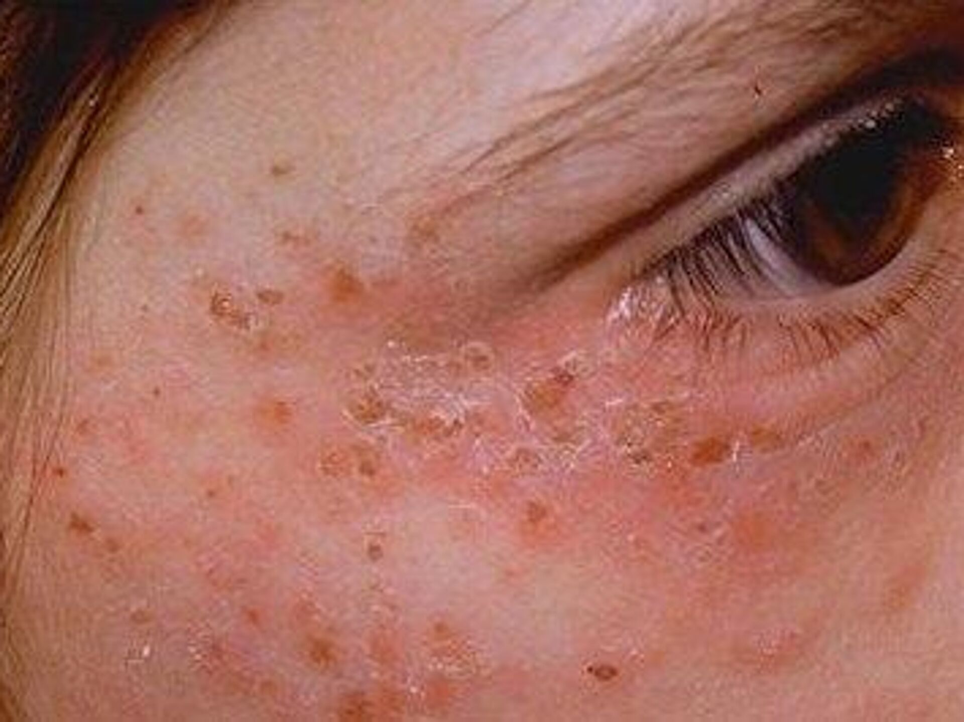 Аллергия на солнце: пятна на коже и причины фотодерматоза