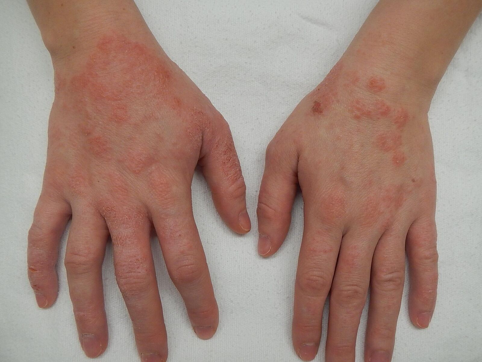 Аллергия у взрослых: симптомы, причины, лечение