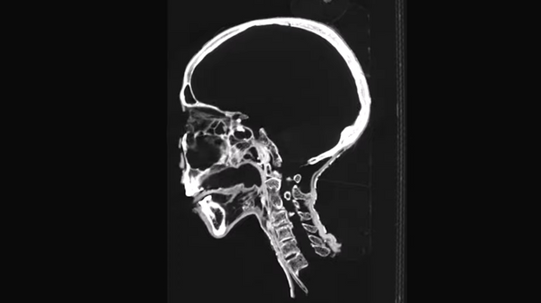 Сканирование головы мумии в больница Тунбридж Уэллс