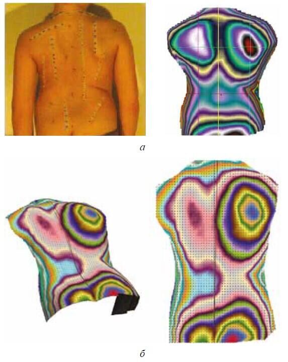 Рельефы спины ребенка с прогрессирующим сколиозом: а — спина ребенка и колорированная карта ее рельефа на начальном этапе формирования патологии; б — рельеф спины спустя два года в 3D-варианте и в виде плоской карты  - РИА Новости, 1920, 01.08.2022