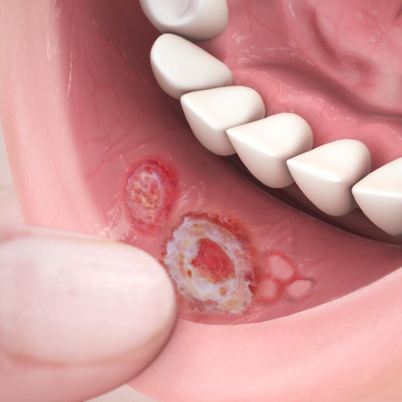 Язвы в полости рта - «Стоматология на Марата 31»