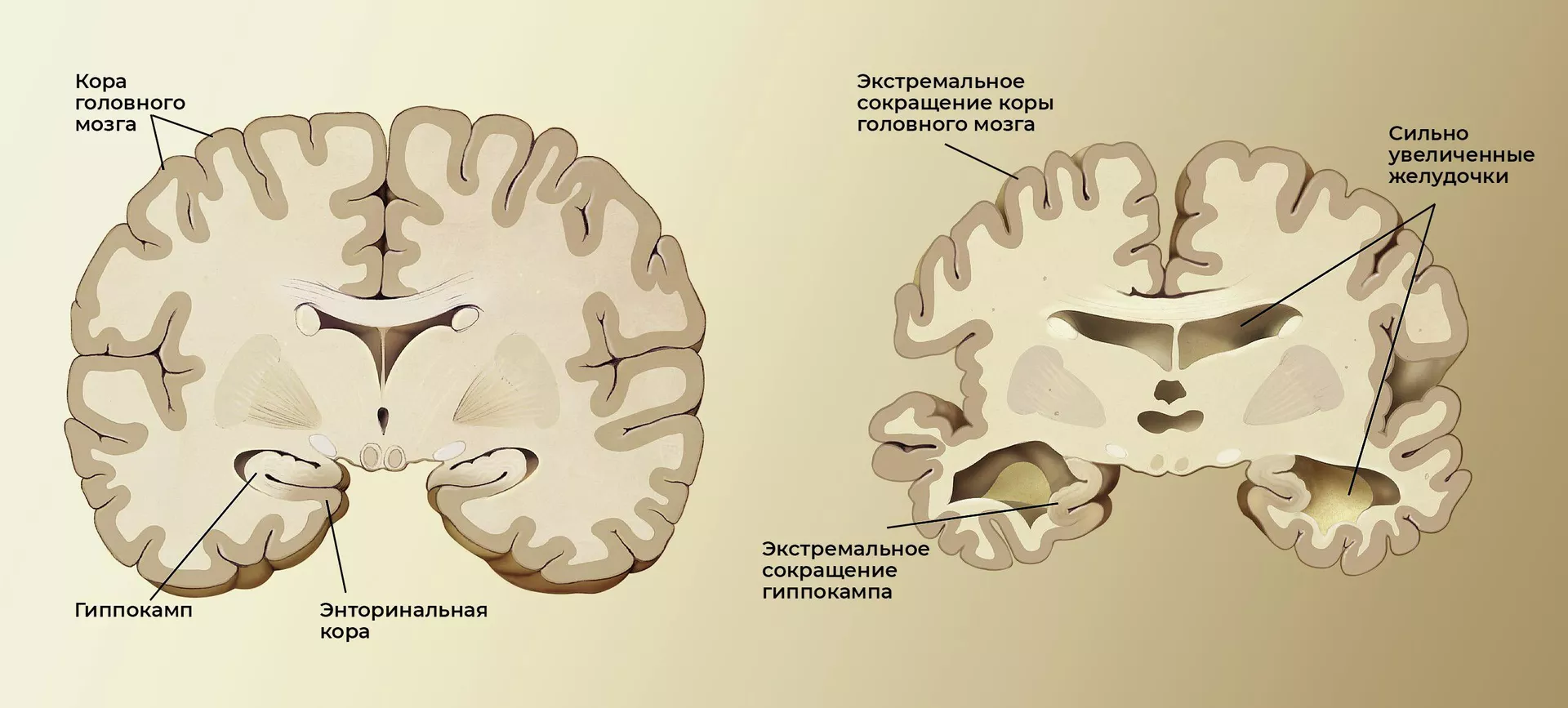 Мозг здорового пожилого человека (слева) и пациента с болезнью Альцгеймера (справа) - РИА Новости, 1920, 03.10.2022