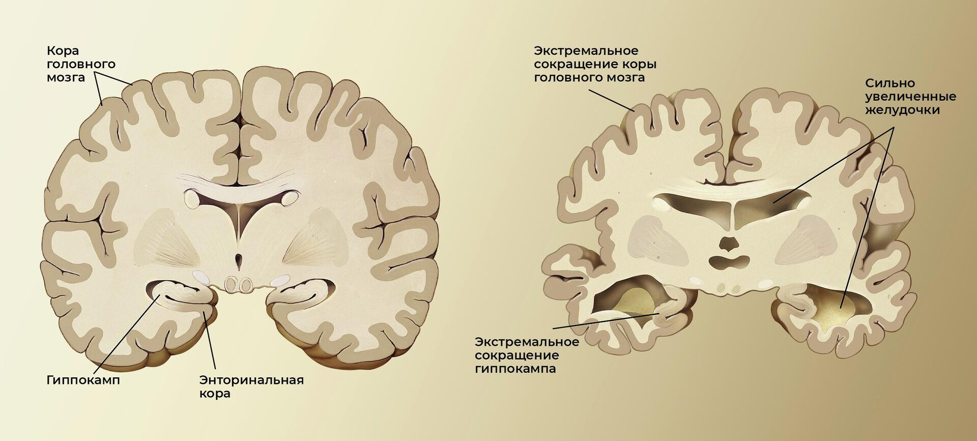 Мозг здорового пожилого человека (слева) и пациента с болезнью Альцгеймера (справа) - РИА Новости, 1920, 26.02.2024