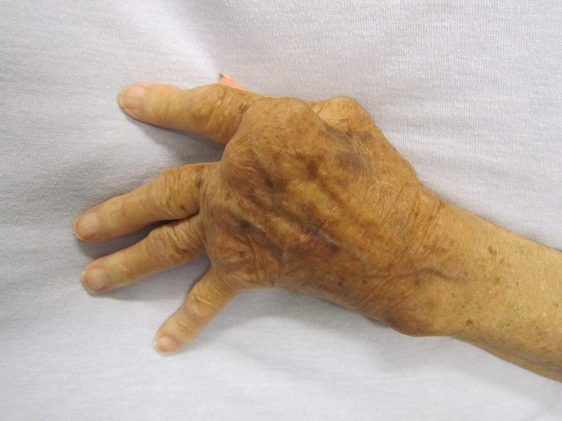 Рука человека, пораженного ревматоидным артритом - РИА Новости, 1920, 27.10.2022