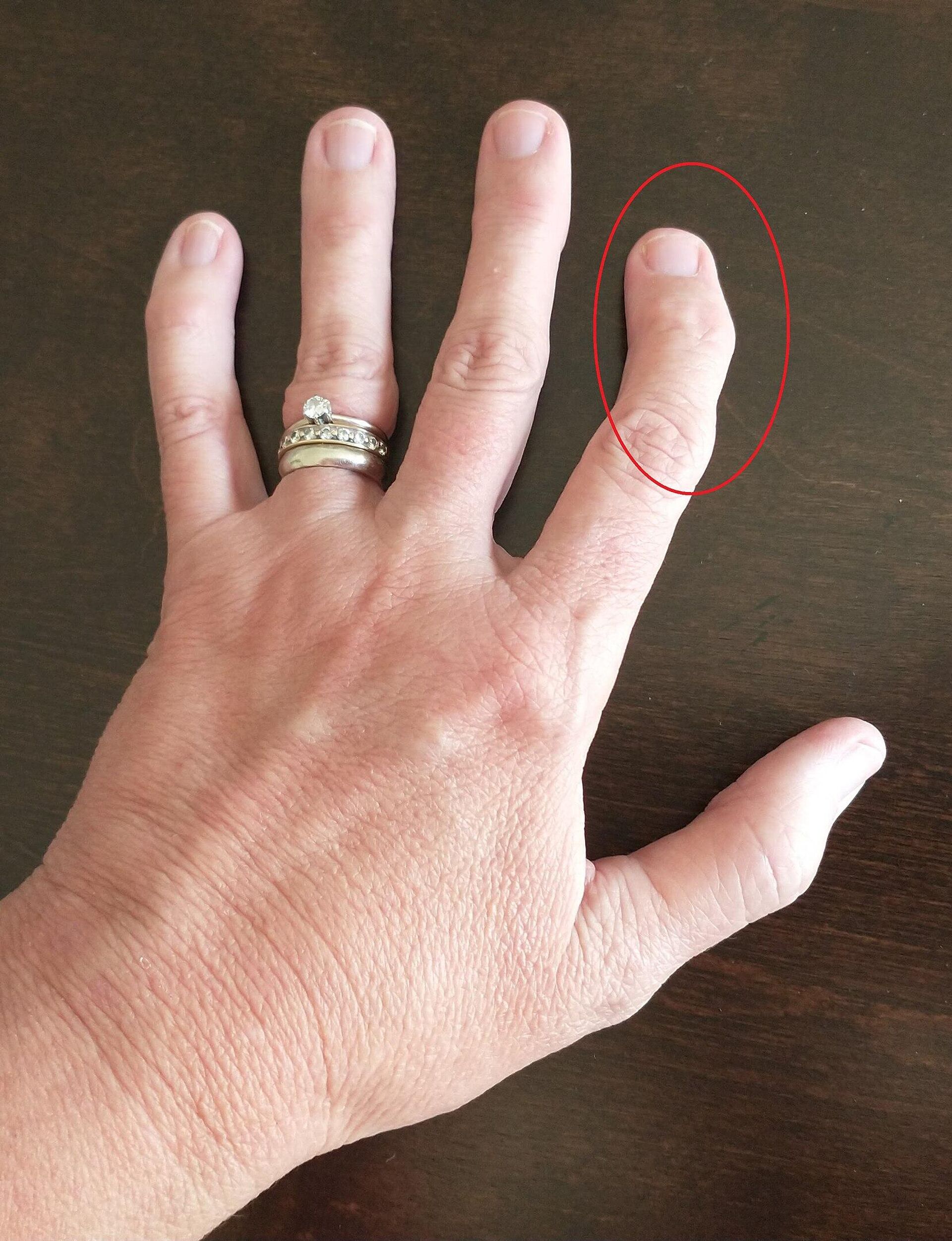 Остеоартроз указательного пальца левой руки у 63-летней женщины - РИА Новости, 1920, 27.10.2022