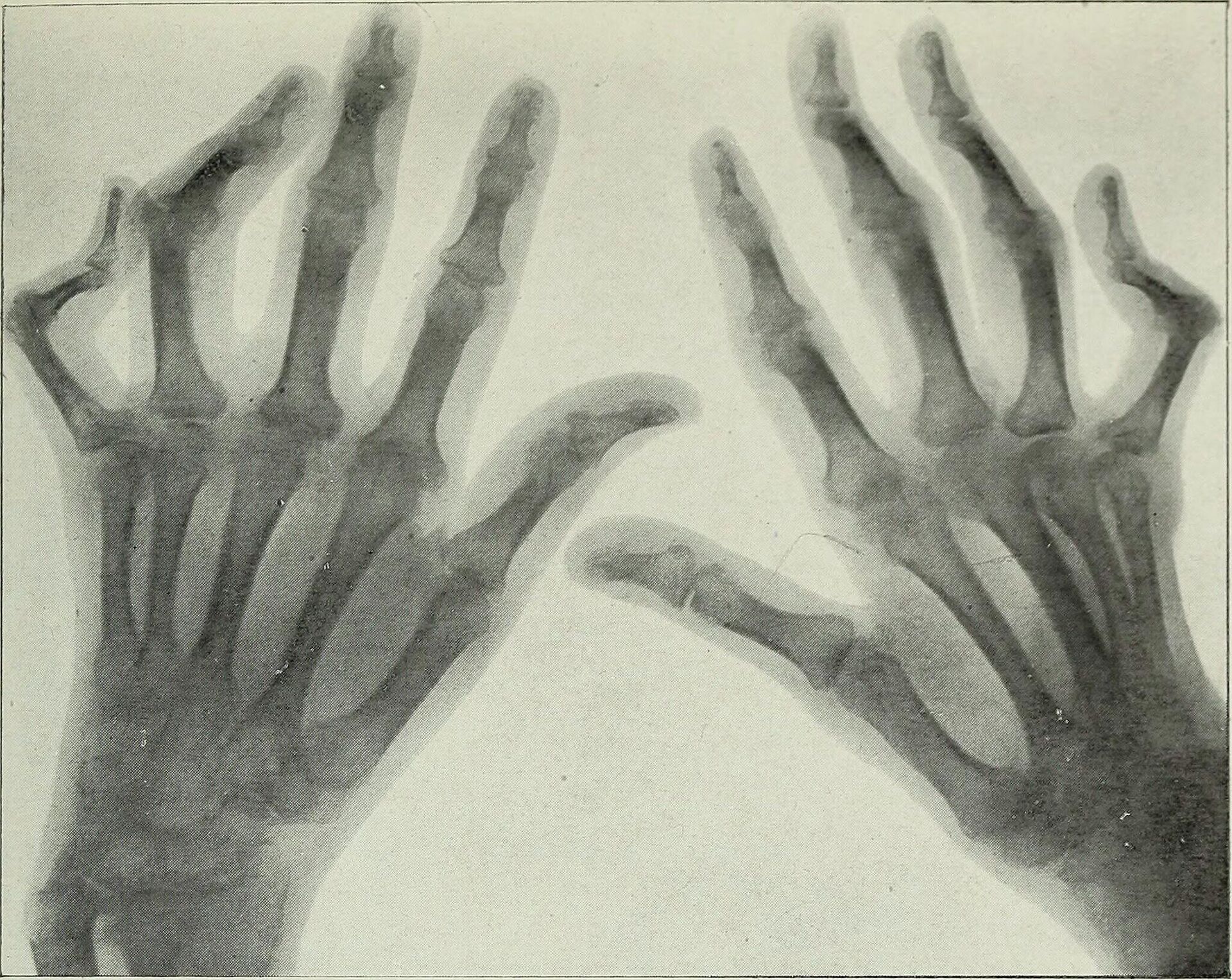 Руки человека, пораженного артритом - РИА Новости, 1920, 27.10.2022