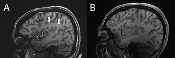 МРТ мозга пациента с мигренью (слева) и участника из контрольной группы (справа). Стрелками показана область полуовального центра с расширенными периваскулярными пространствами