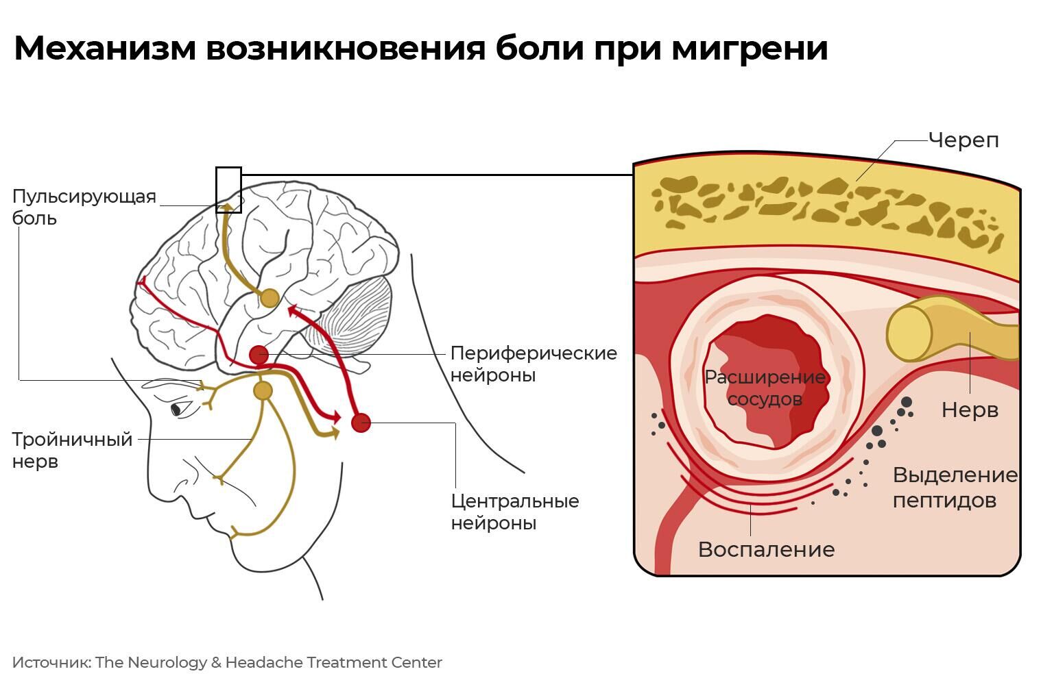 Механизм возникновения боли при мигрени - РИА Новости, 1920, 19.12.2022